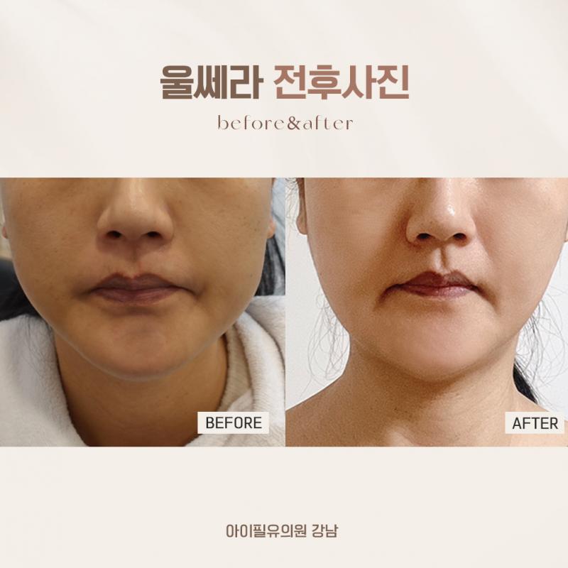 울쎄라 300샷, 덴서티 300샷 시술 전/ 시술 한 달 반 후