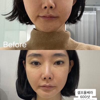 울쎄라 600샷 후기, 두달 후 경과 사진