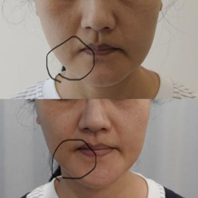 마리오네트 주름 , 강남 세르프리프팅, 세르프 통증